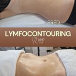 Lymfocontouring