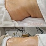 Lymfocontouring