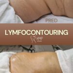 Lymfocontouring
