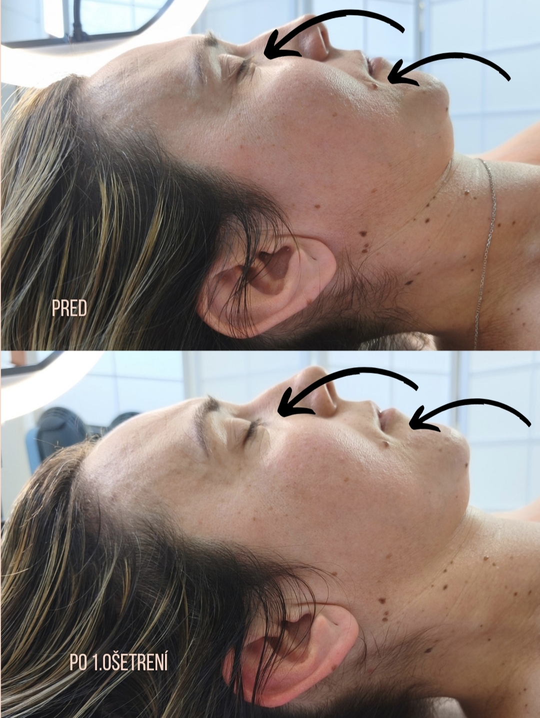 Prirodzený facelift
