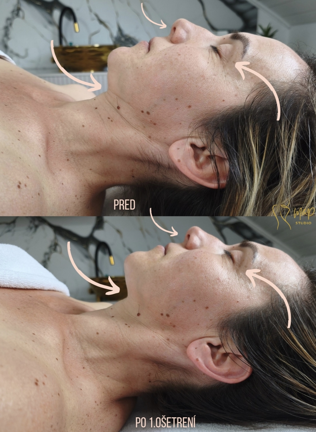 Manuálna remodelácia tváre v M&P Studio